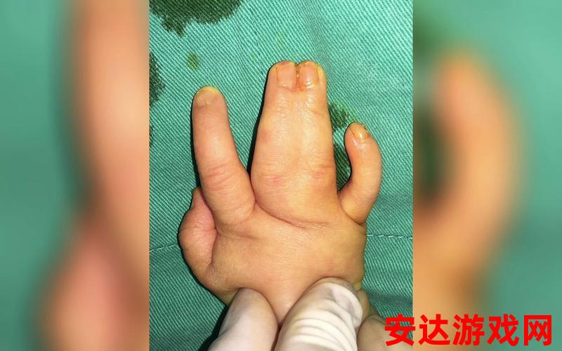 小孩出生3个手指连在一起：小孩出生时三个手指连在一起是怎么回事？